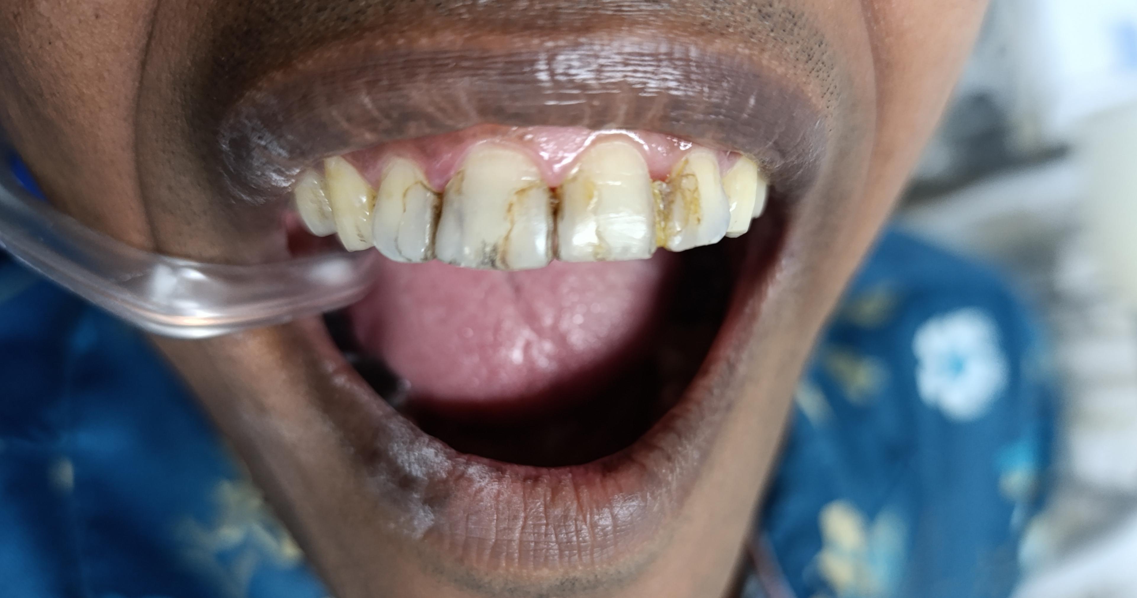 Restoration or filling